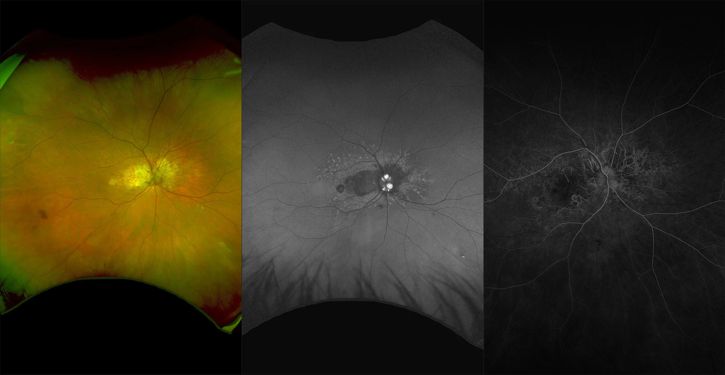 California - Angioid Streaks with Macular Druen and Peripheral Drusen, RG, AF, FA