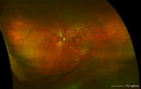 ultra-widefield retinal imaging technology