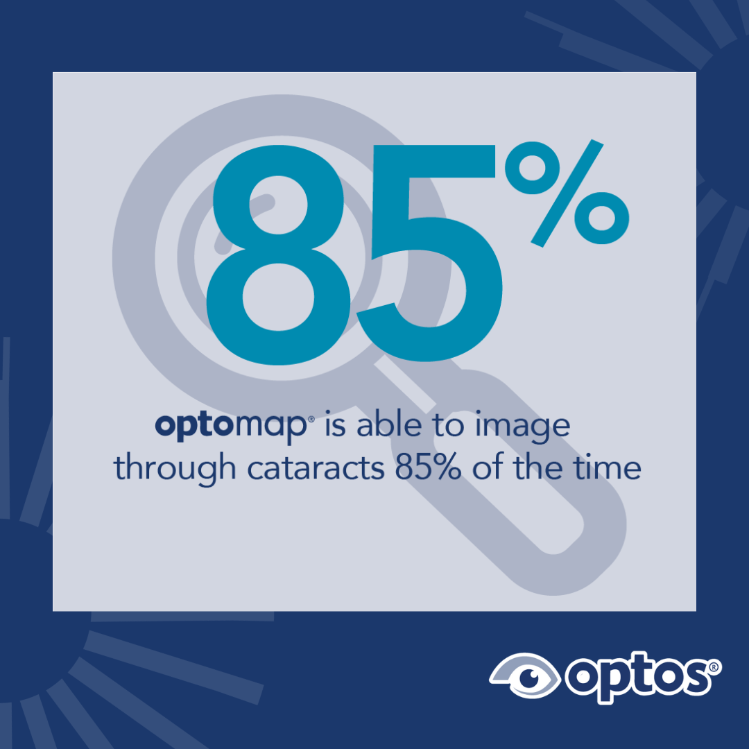 cataract infographic