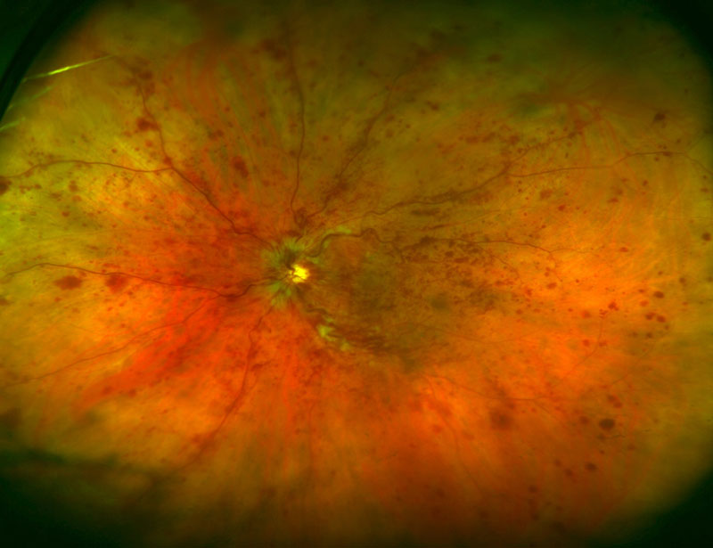 monitoring patients after retinal bleeding