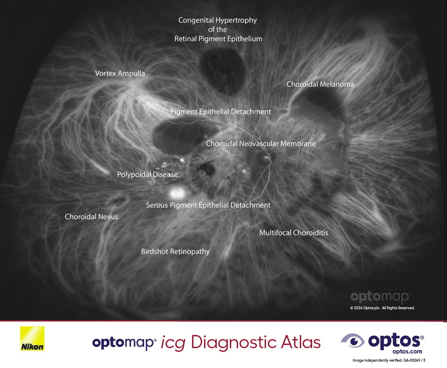 Diagnostic Atlas - optomap icg