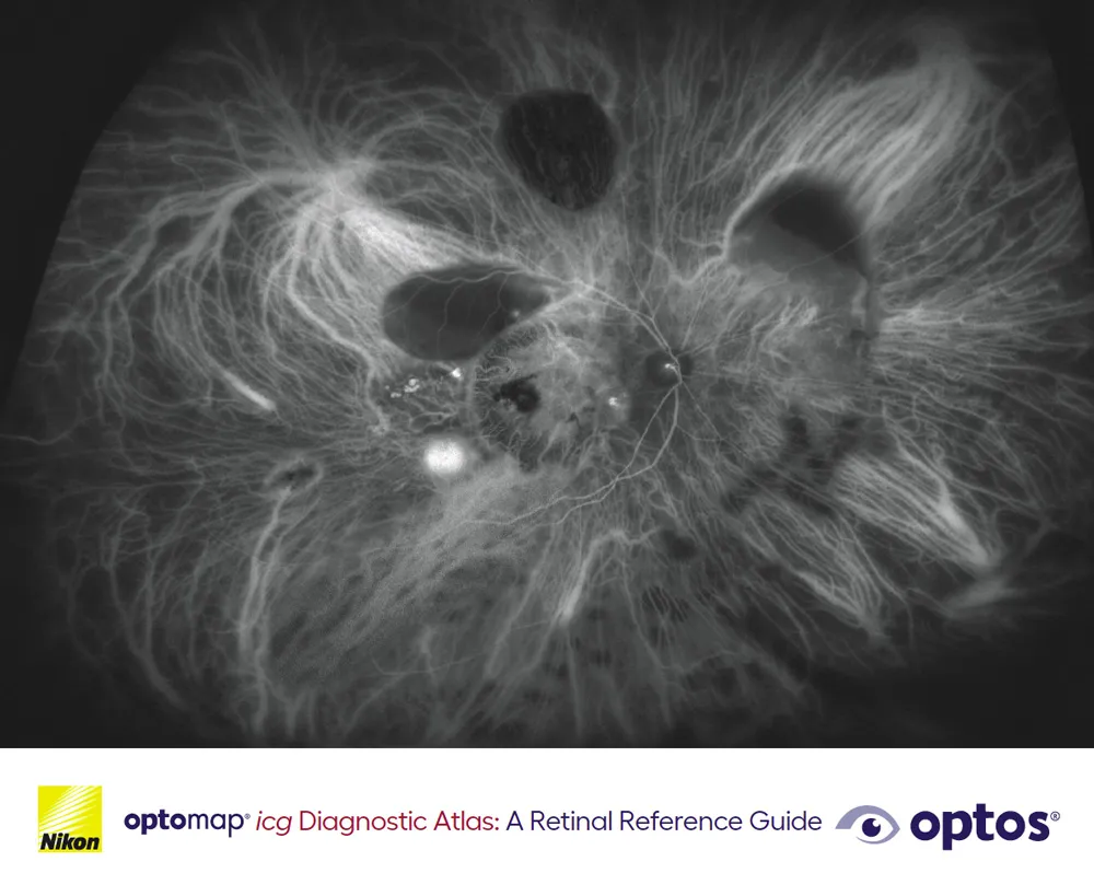 Diagnostic Atlas Booklet – optomap icg