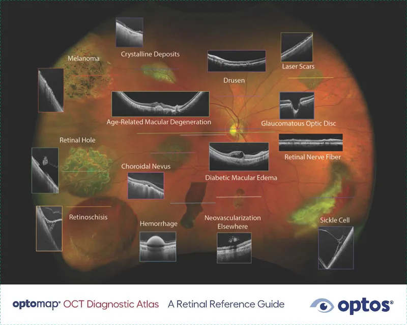 Diagnostic Atlas Booklet – optomap OCT