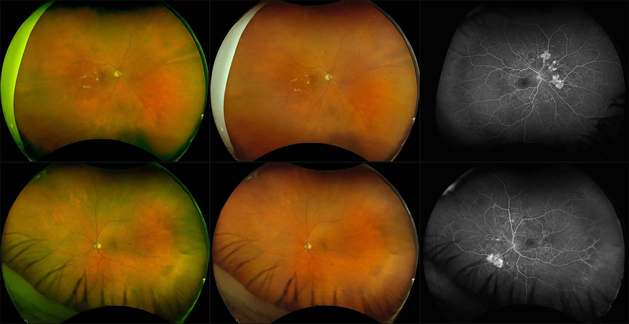 California - Moderate Non-proliferative Diabetic Retinopathy, RG, RGB, FA