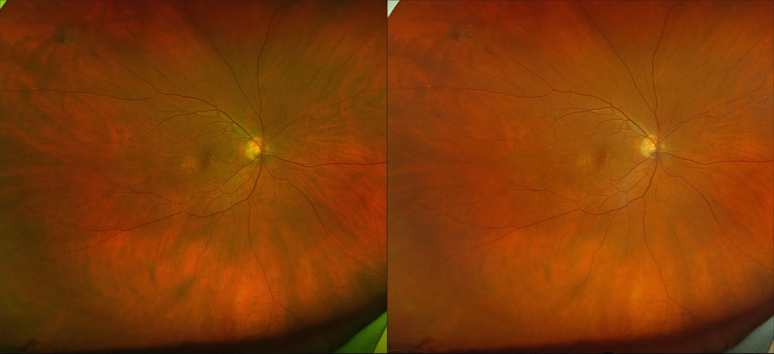 California - Ectopic Choroidal Neovascularization, RG, RGB