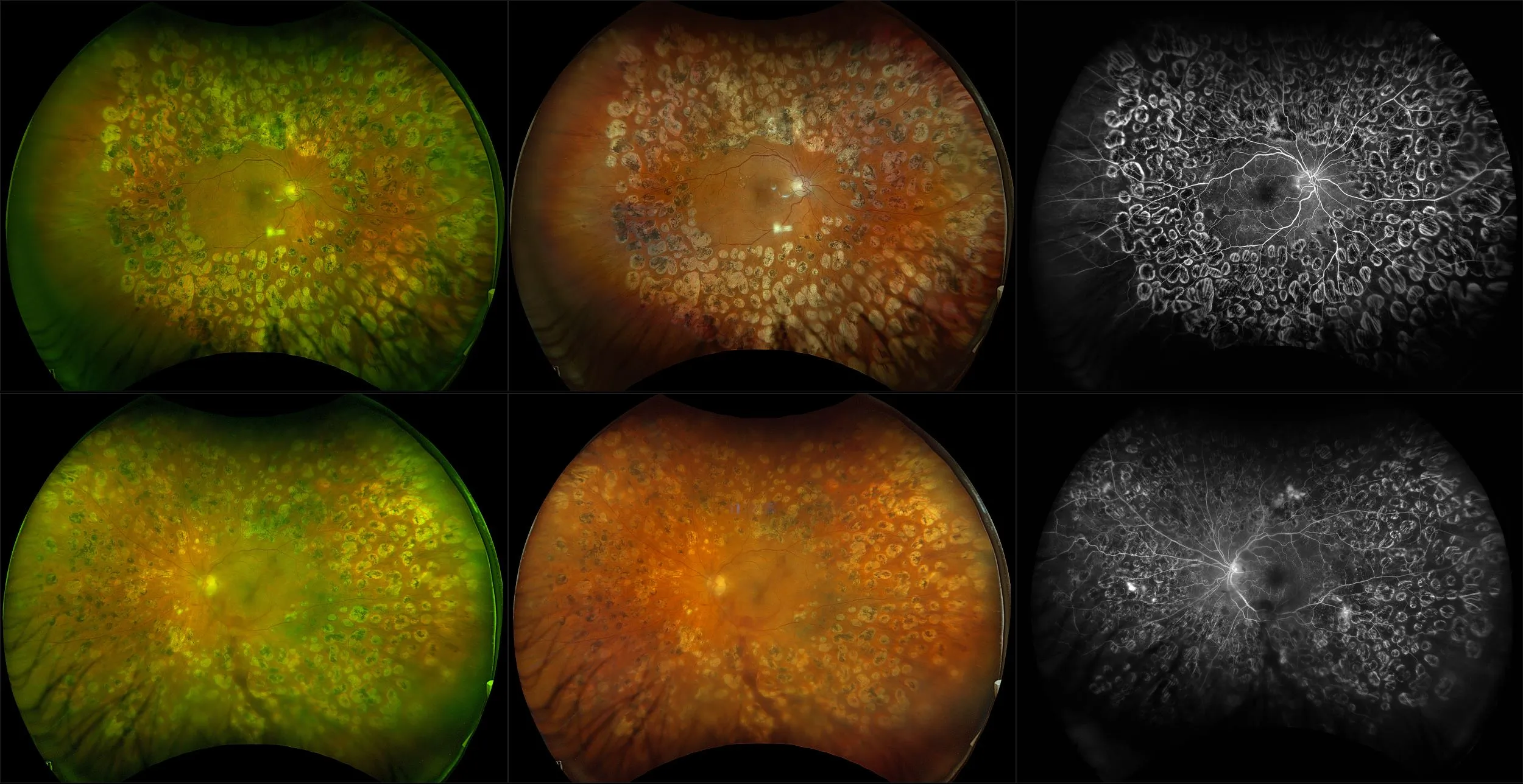 California - Active Proliferative Diabetic Retinopathy, RG, RGB, FA