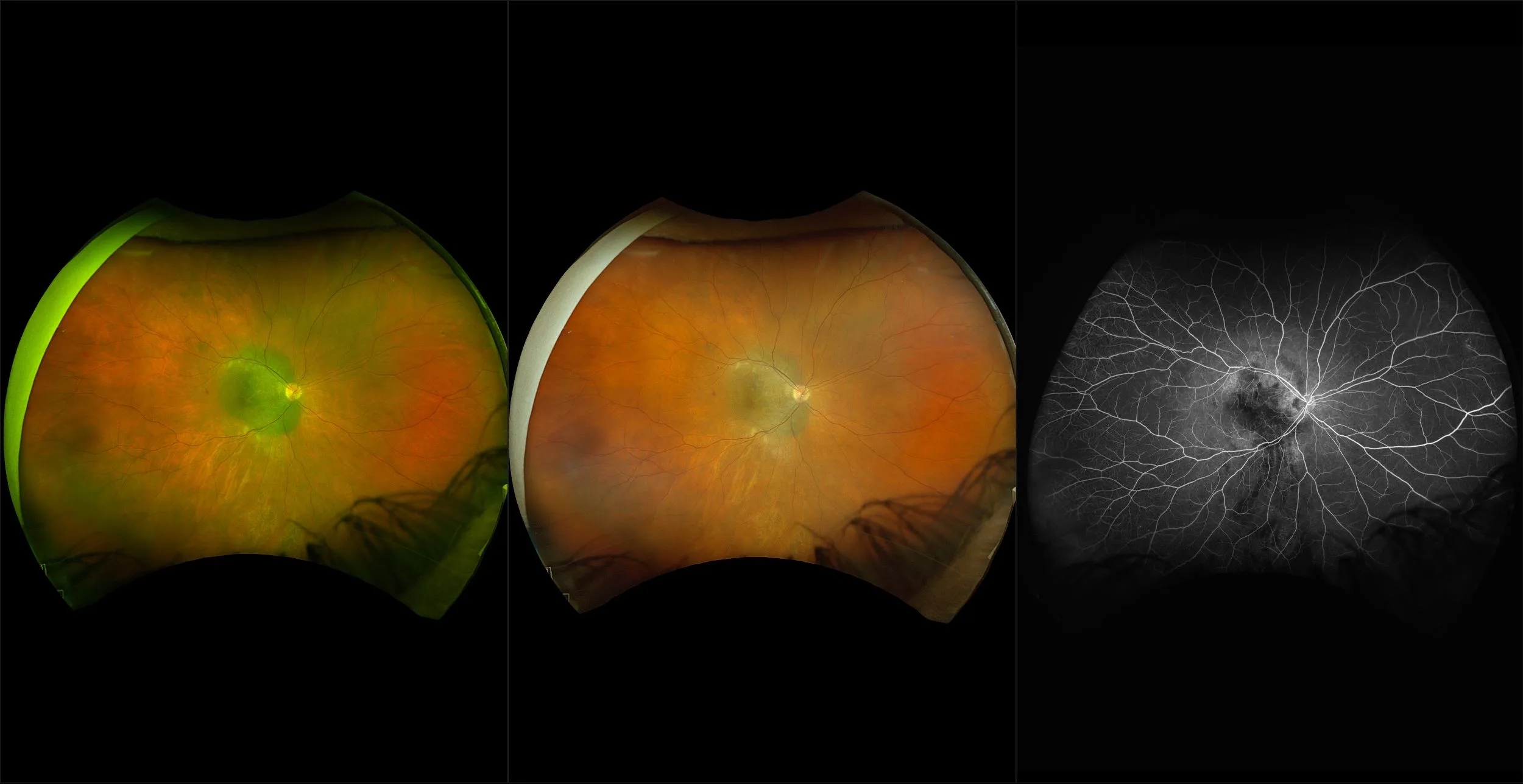 California - Radiation Retinopathy with Choroidal Melanoma, RG, RGB, FA