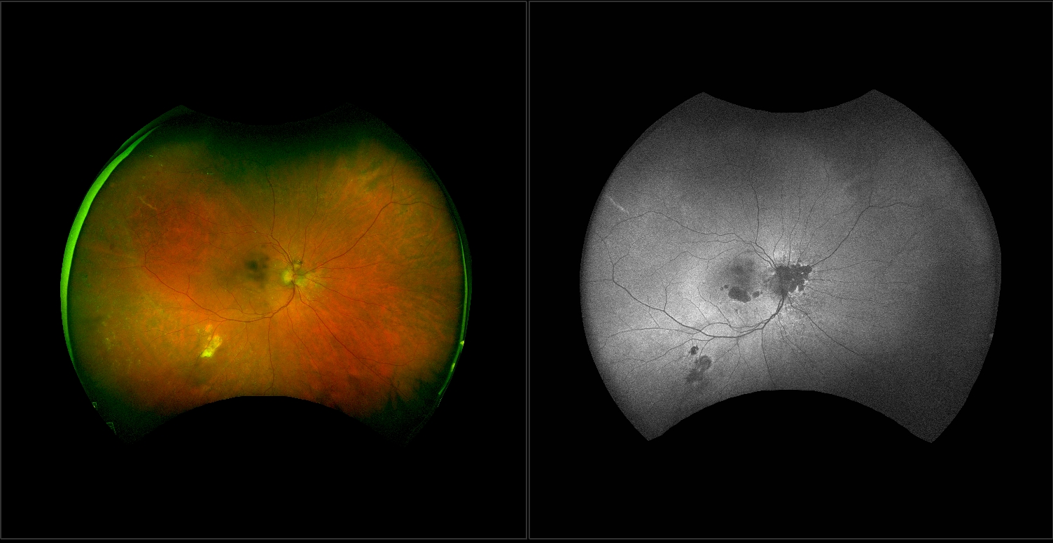 Age-related Macular Degeneration (amd)