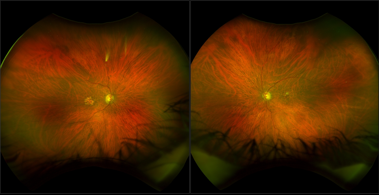 Age-related Macular Degeneration (AMD)