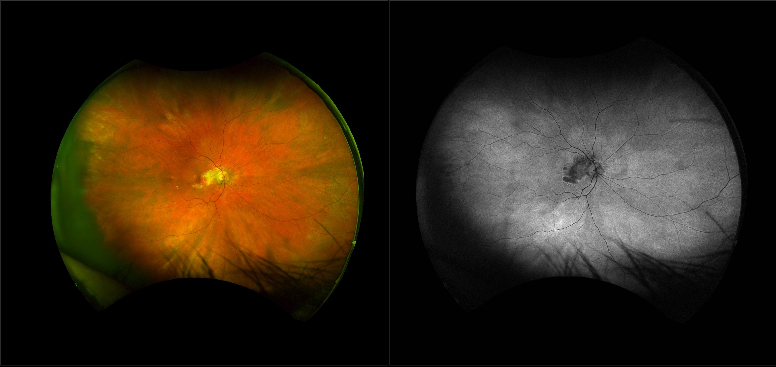 Age-related Macular Degeneration (AMD)