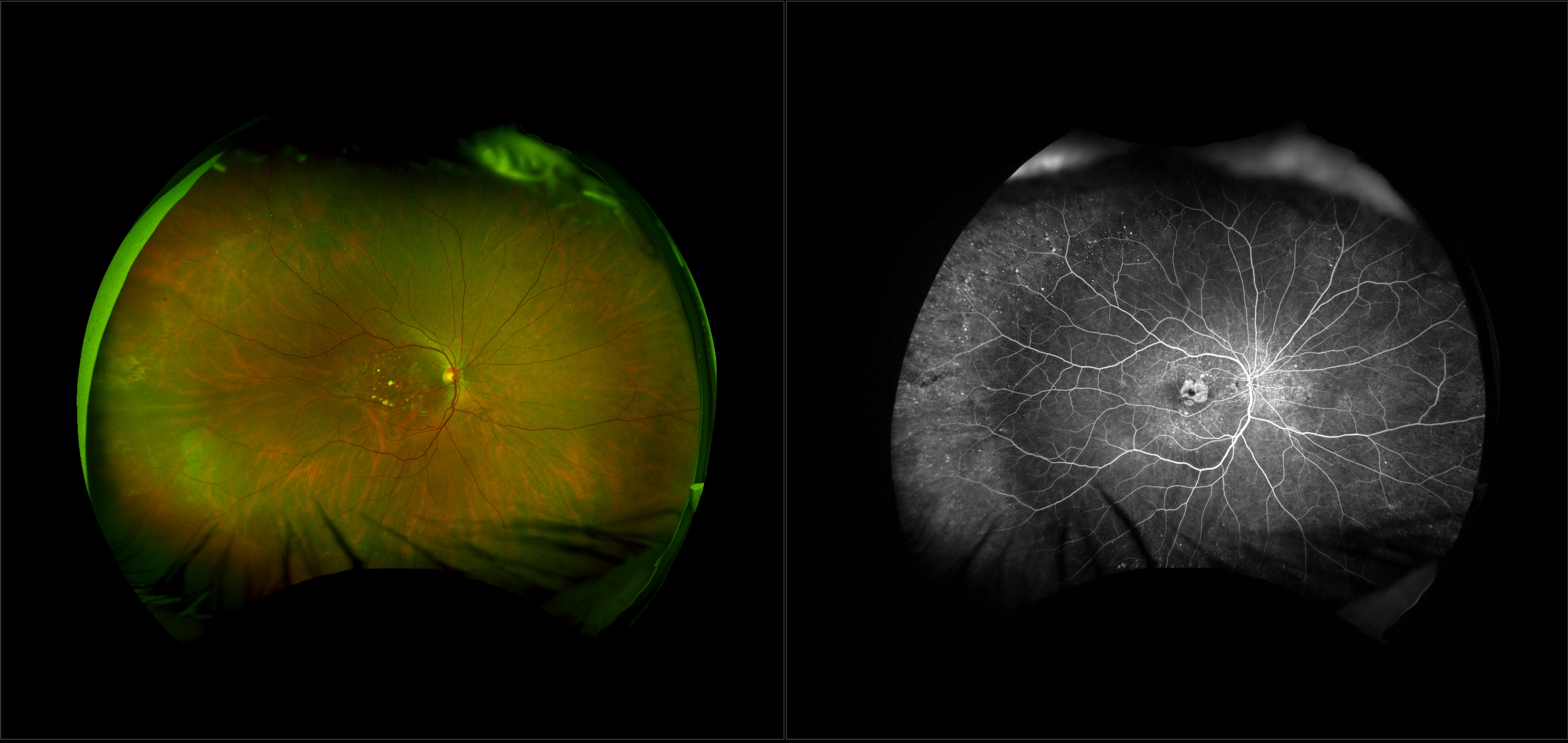 Age-related Macular Degeneration (AMD)