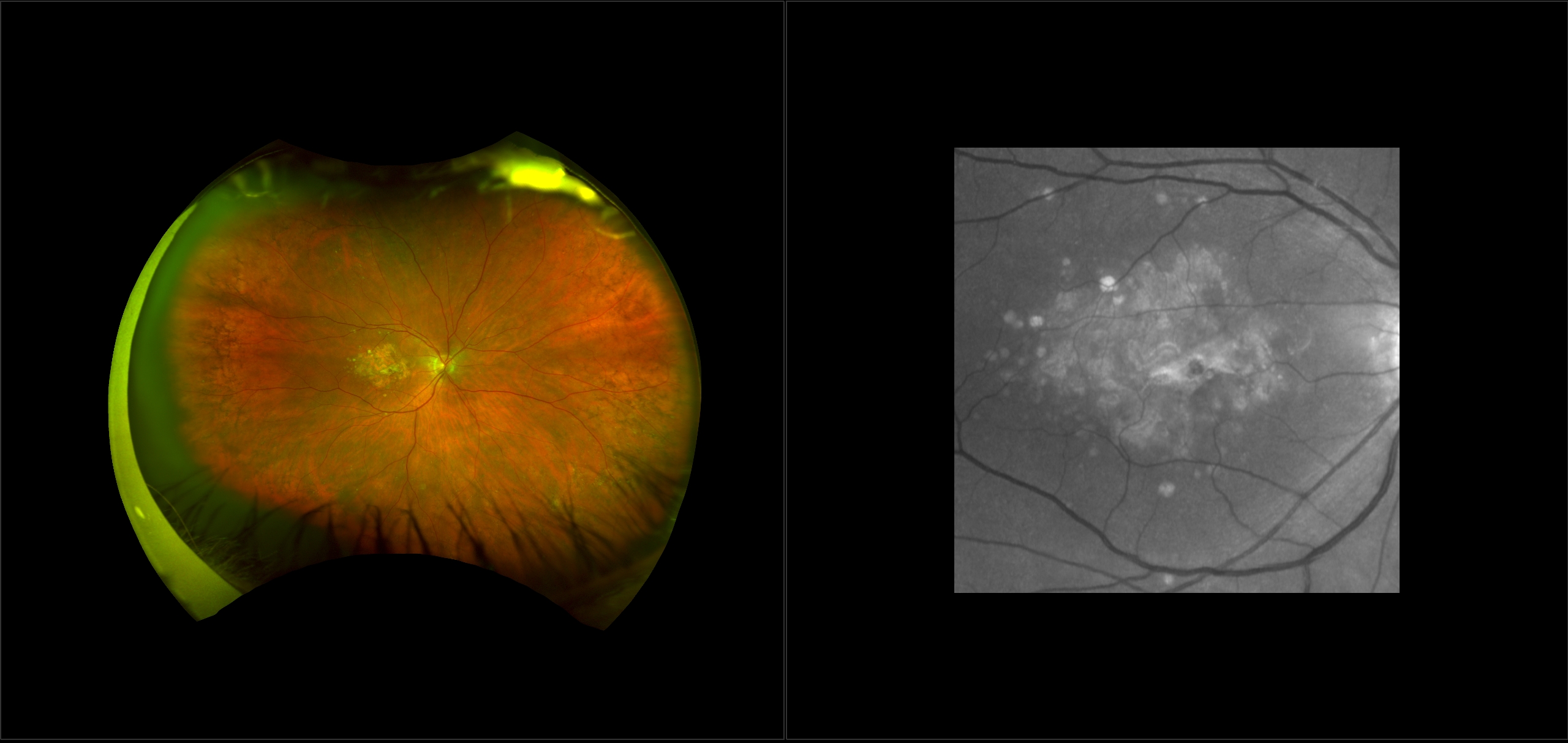 Age-related Macular Degeneration (AMD)