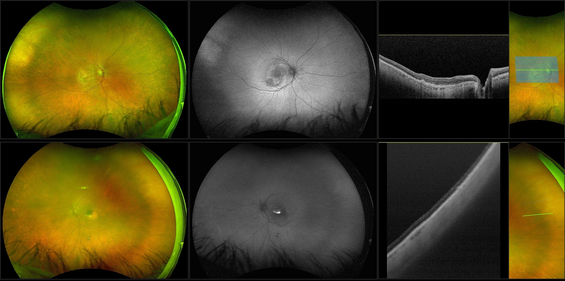 Silverstone - Wet AMD with Active Neovascularization and Geographic Atrophy, RG, AF, OCT