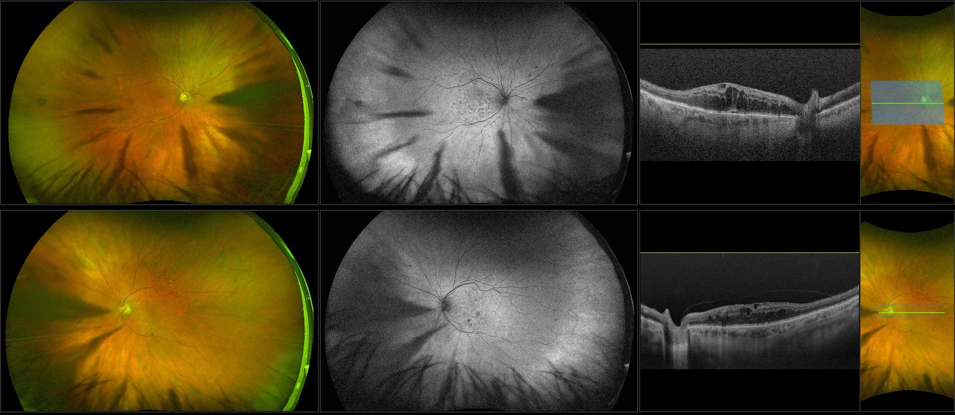 Silverstone - Diabetic Retinopathy with Macular Edema, RG, AF, OCT