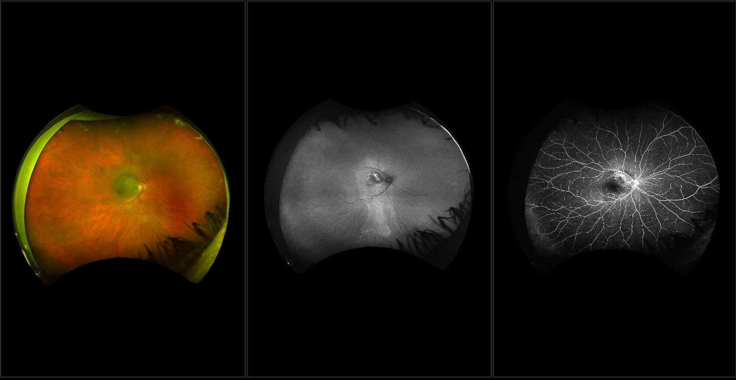 Age-related Macular Degeneration (AMD)