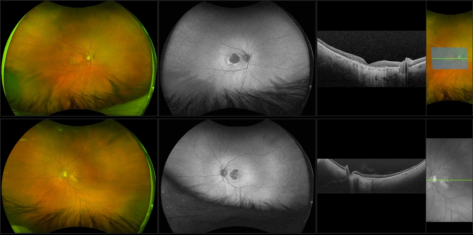 Silverstone - Dry AMD Advanced with Subfoveal Involvement and Geographic Atrophy, RG, AF, OCT