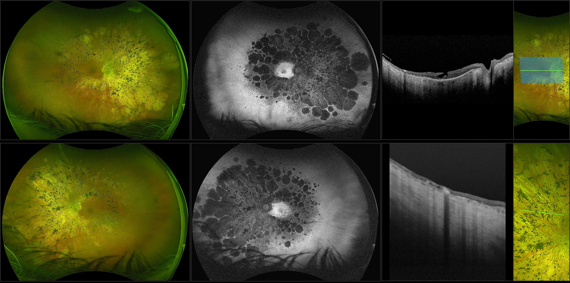 Silverstone - Retinitis Pigmentosa with Macular Hole and Geographic Atrophy, RG, AF, OCT