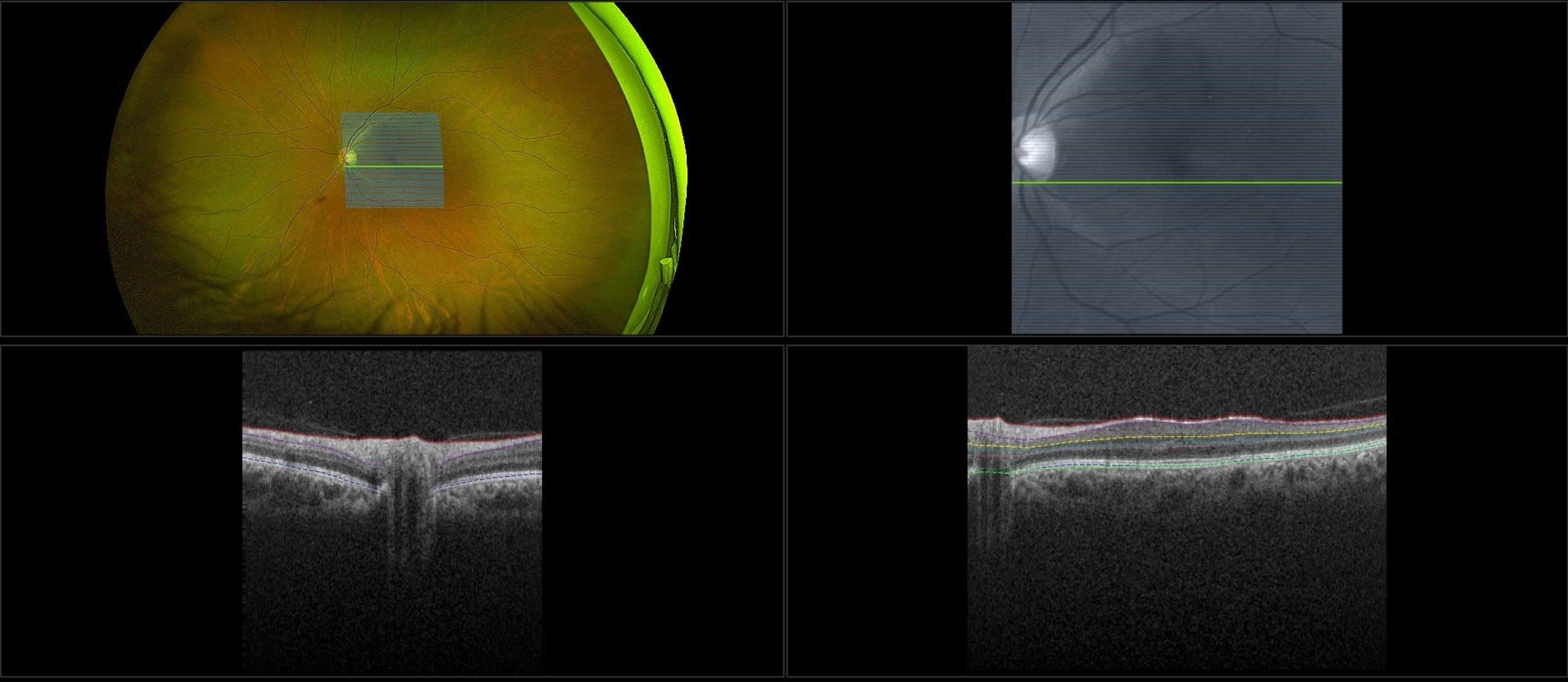 Monaco - Epiretinal Membrane, RG, OCT