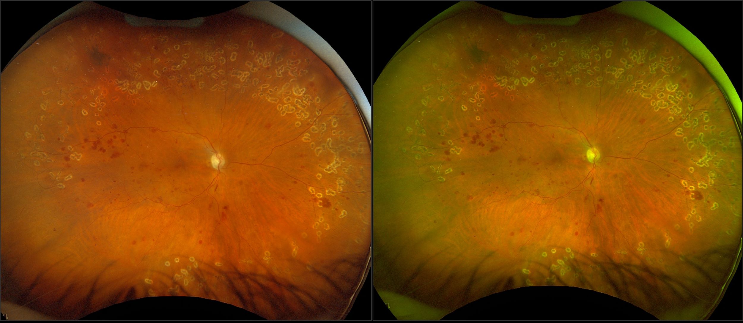 California - Proliferative Diabetic Retinopathy with PRP, RG, RGB