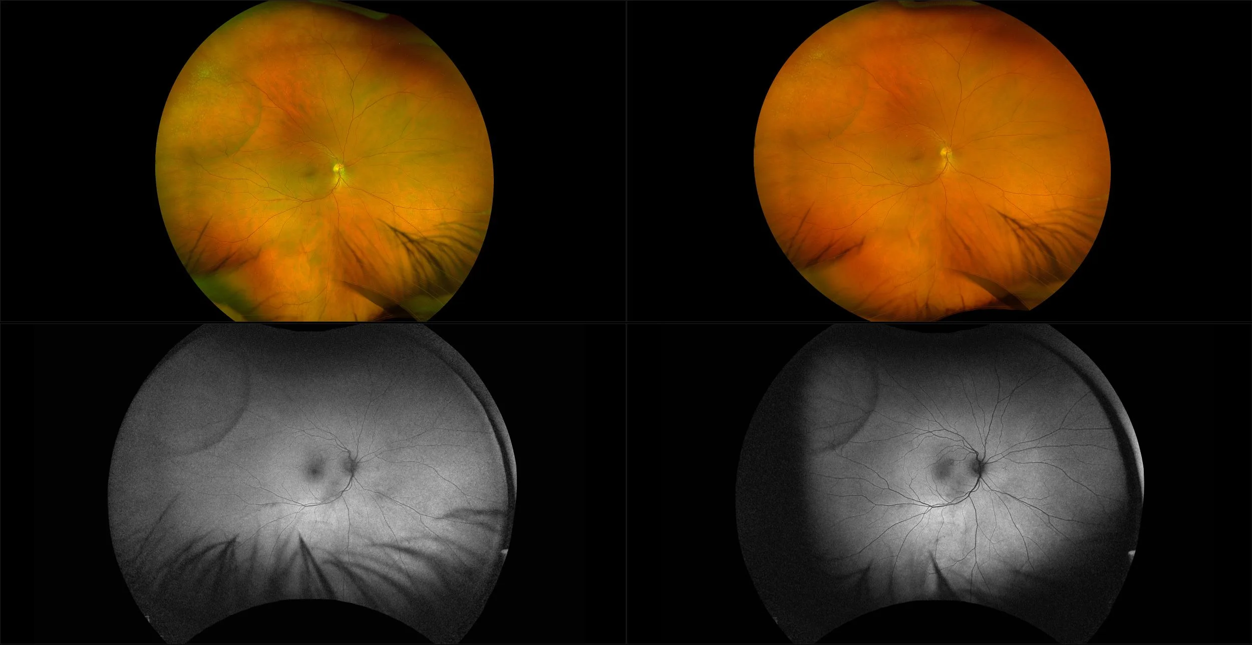 California - Degenerative Retinoschisis - Montage - RG, RGB, AF, BAF