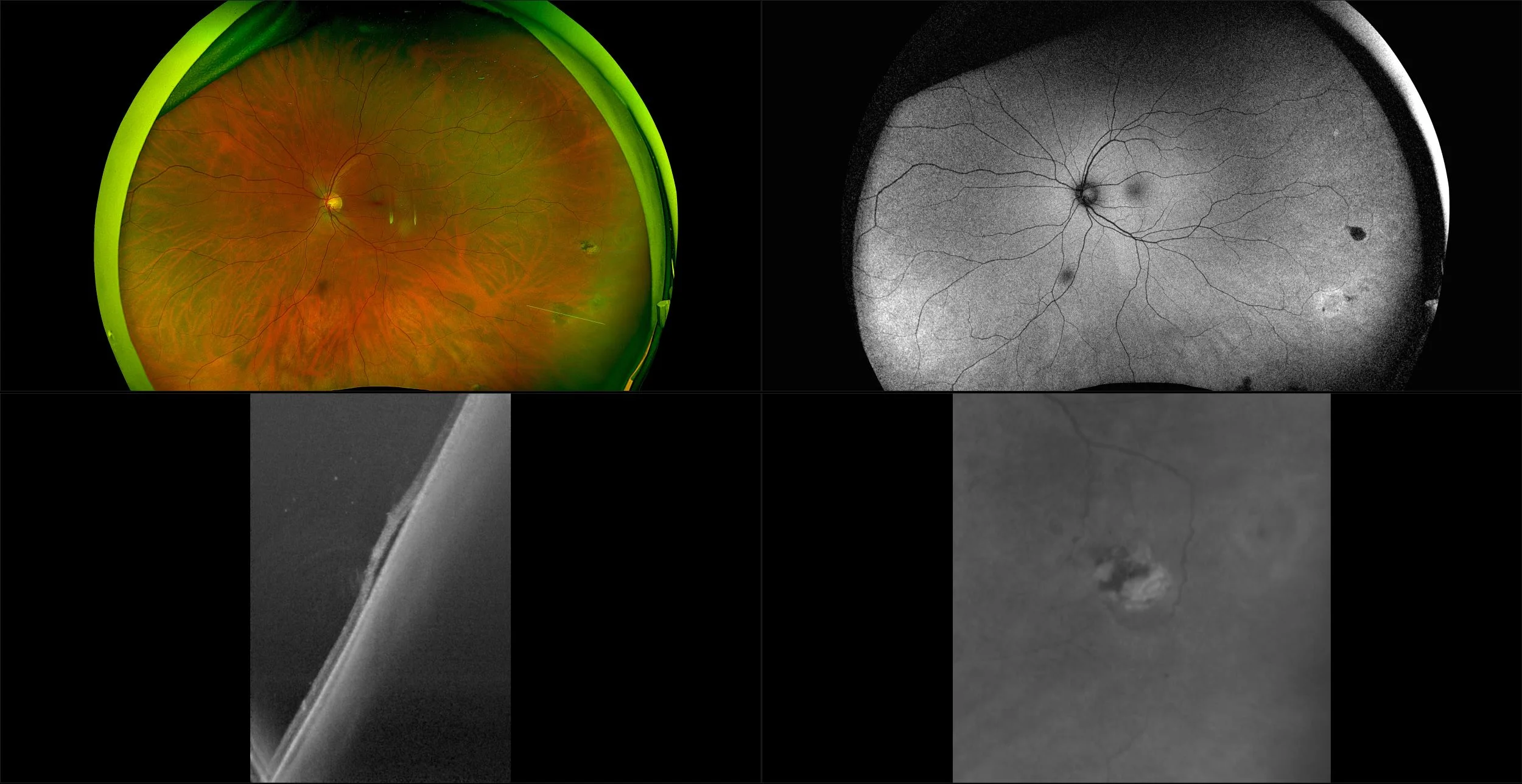 Silverstone - Retinal Hole, RG, AF