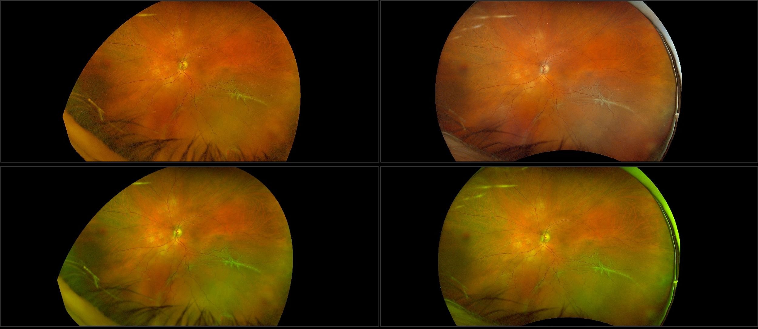 California - Retinal Detachment - Montage, RG, RGB