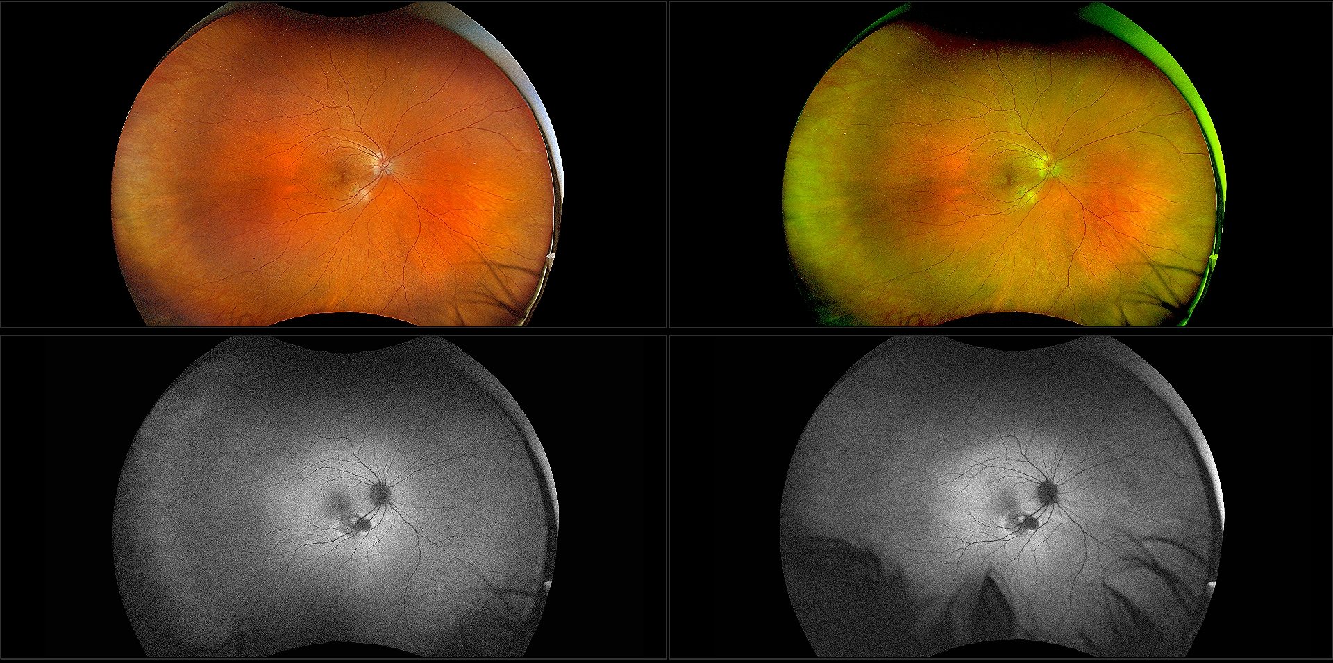 California - Idiopathic Macular Neovascularization, RG, RGB, AF, BAF