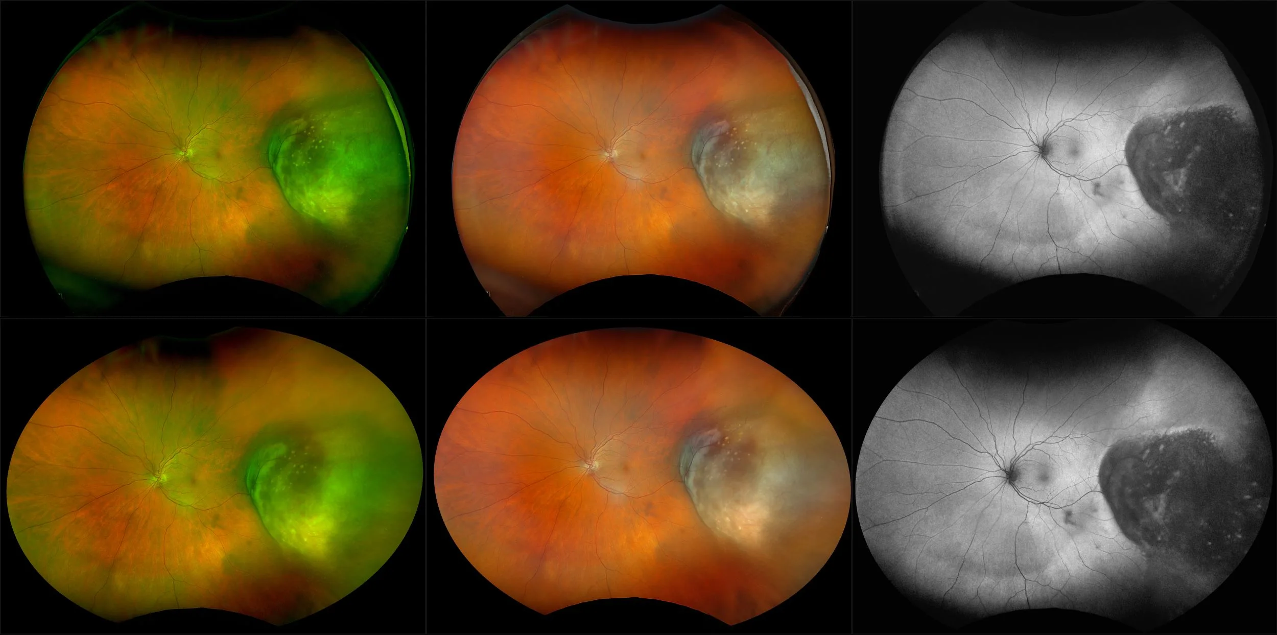 California - Choroidal Melanoma - Montage, RG, RGB, AF