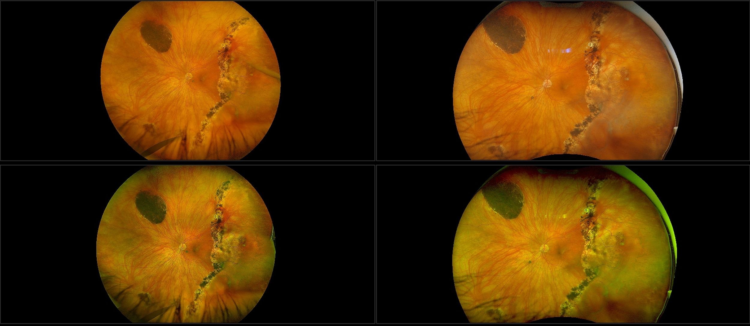 California - Laser Demarcated Retinal Detachment, CHRPE - Montage, RG, RGB