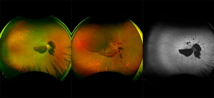 California- Bilateral Vitreous Hemorrhage, RG, RGB, AF