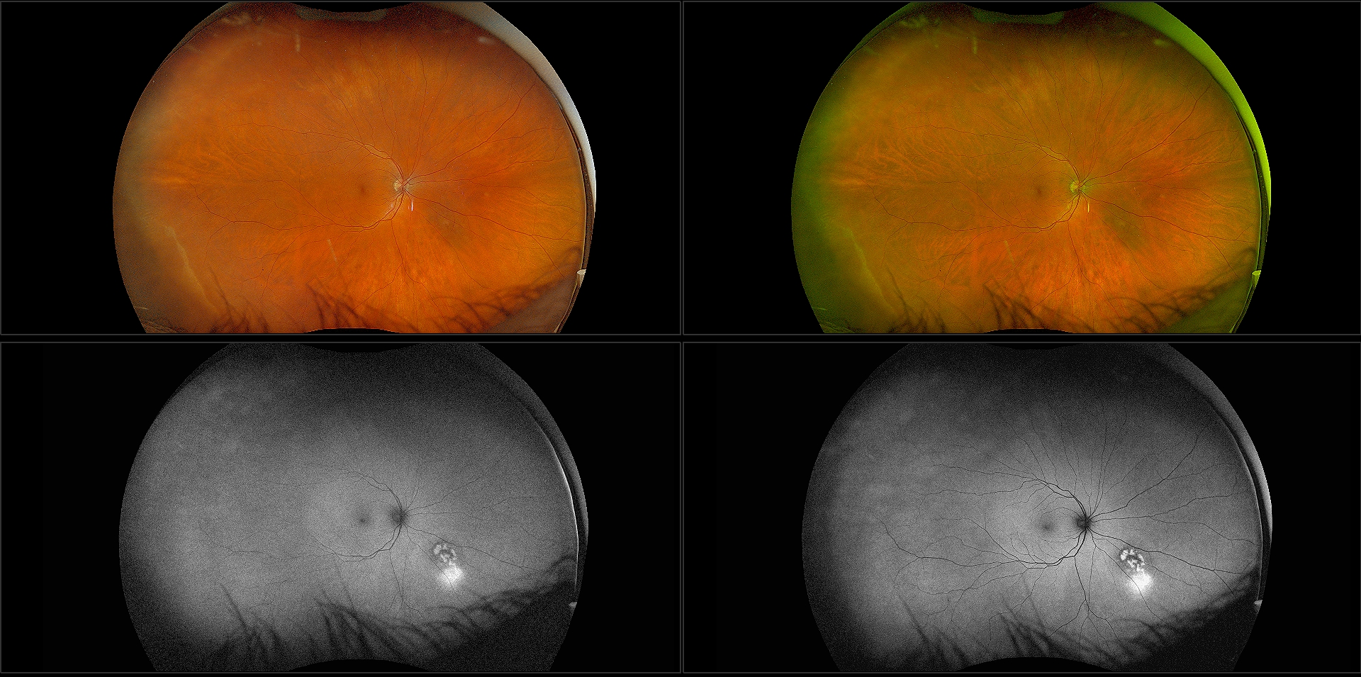 California - Choroidal Nevus,RG, RB, AF, BAF