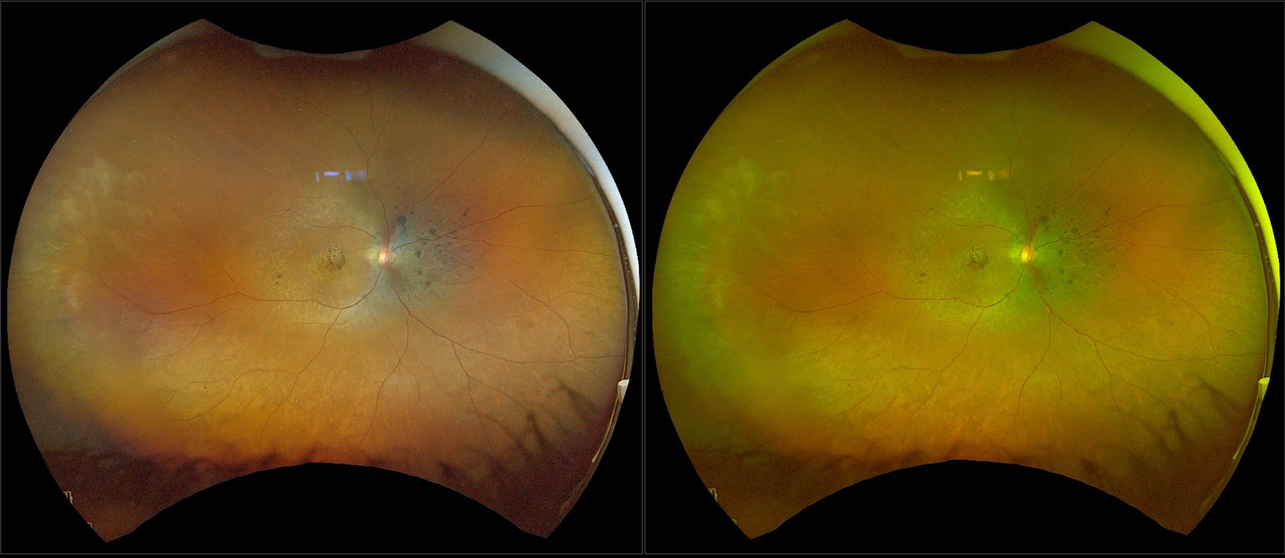 California - Retinitis Pigmentosa, RG, RGB