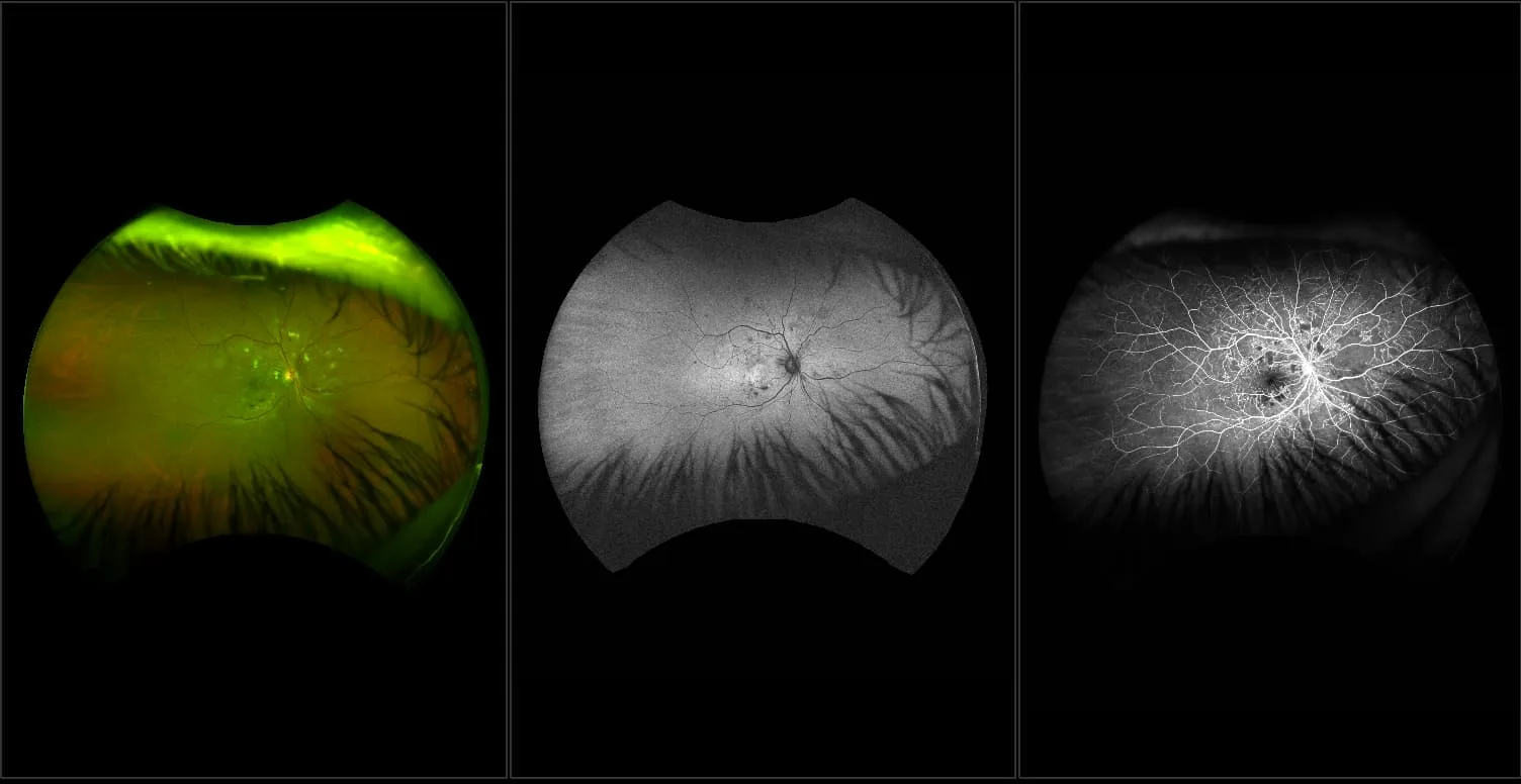 California - IRMA and Non-Perfusion, RG, AF, FA