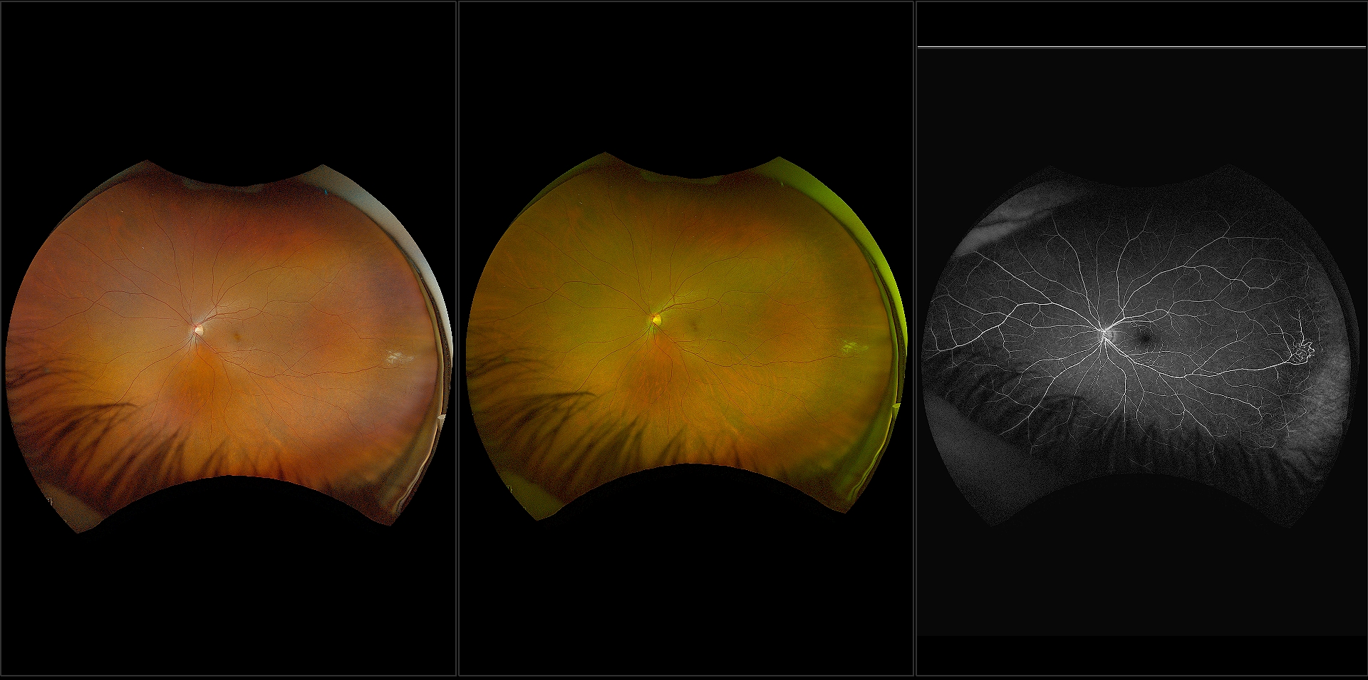 California - Coats Disease, RG, RGB, FA with Transit Phase