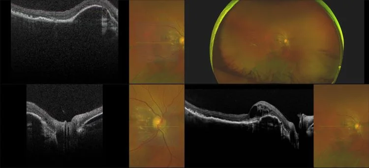 Monaco - Pigment Epithelial Detachment, RG, OCT