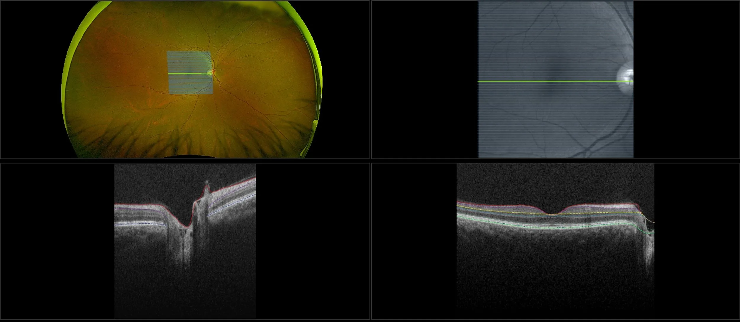 California - Laser Demarcated Retinal Detachment - Montage, RG, RGB