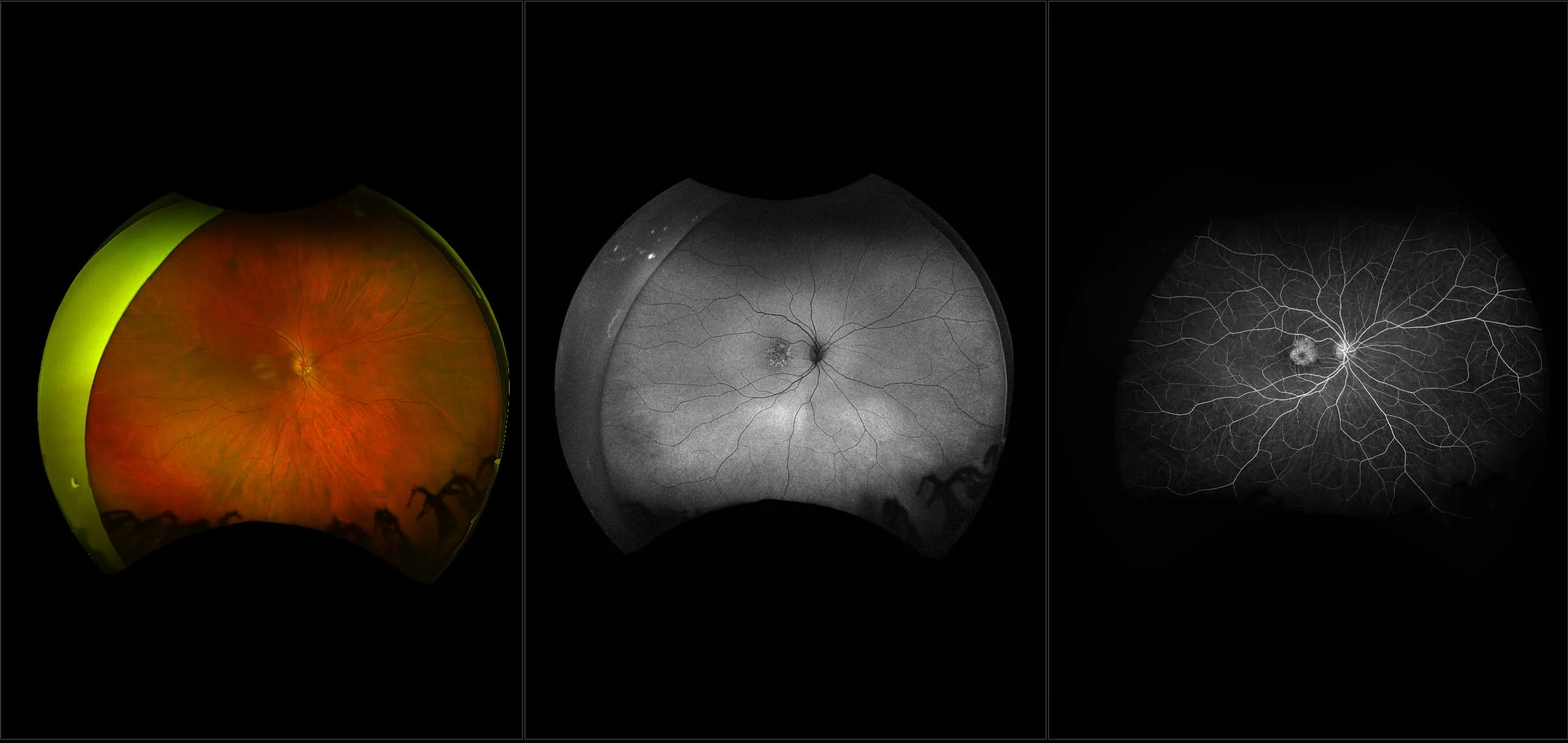 California - Cone-Rod Dystrophy, RG, AF, FA