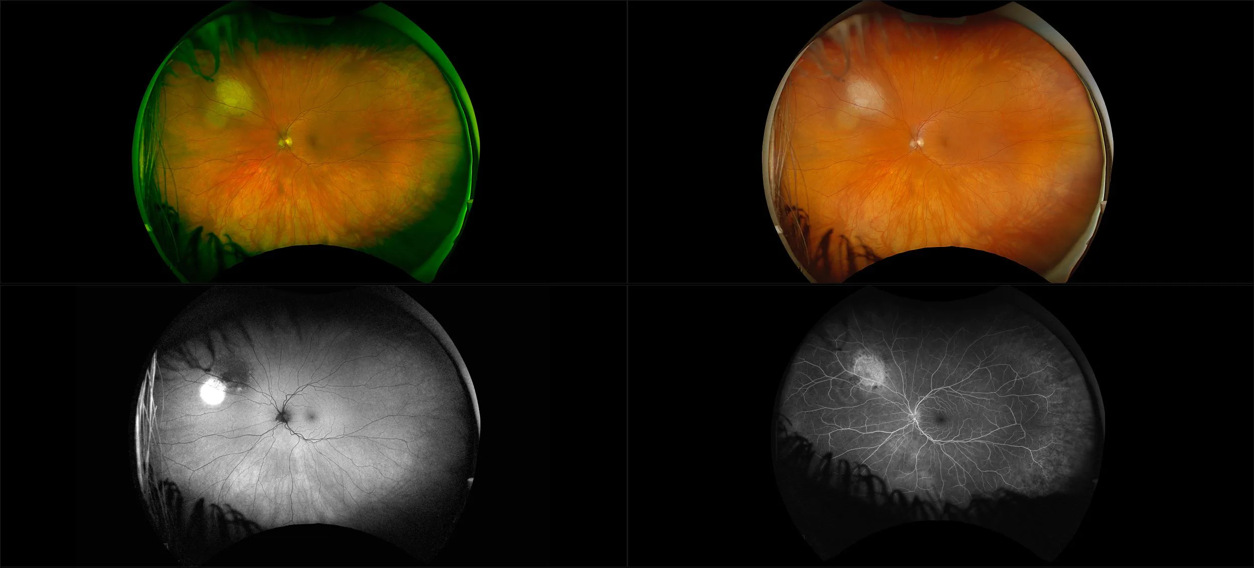 California - Amelanotic Choroidal Nevus, RG, RGB, AF, FA