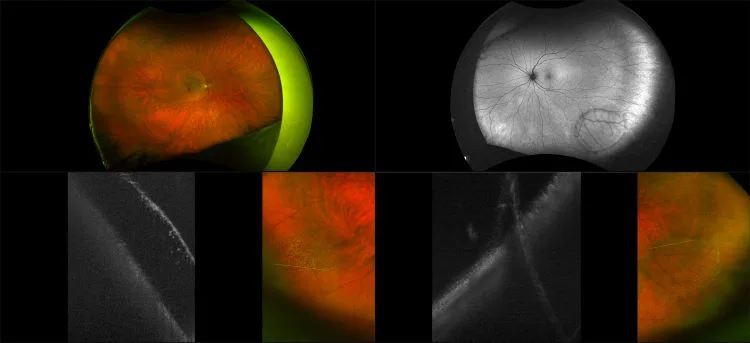 Silverstone - Retinoschisis, RG, AF, OCT