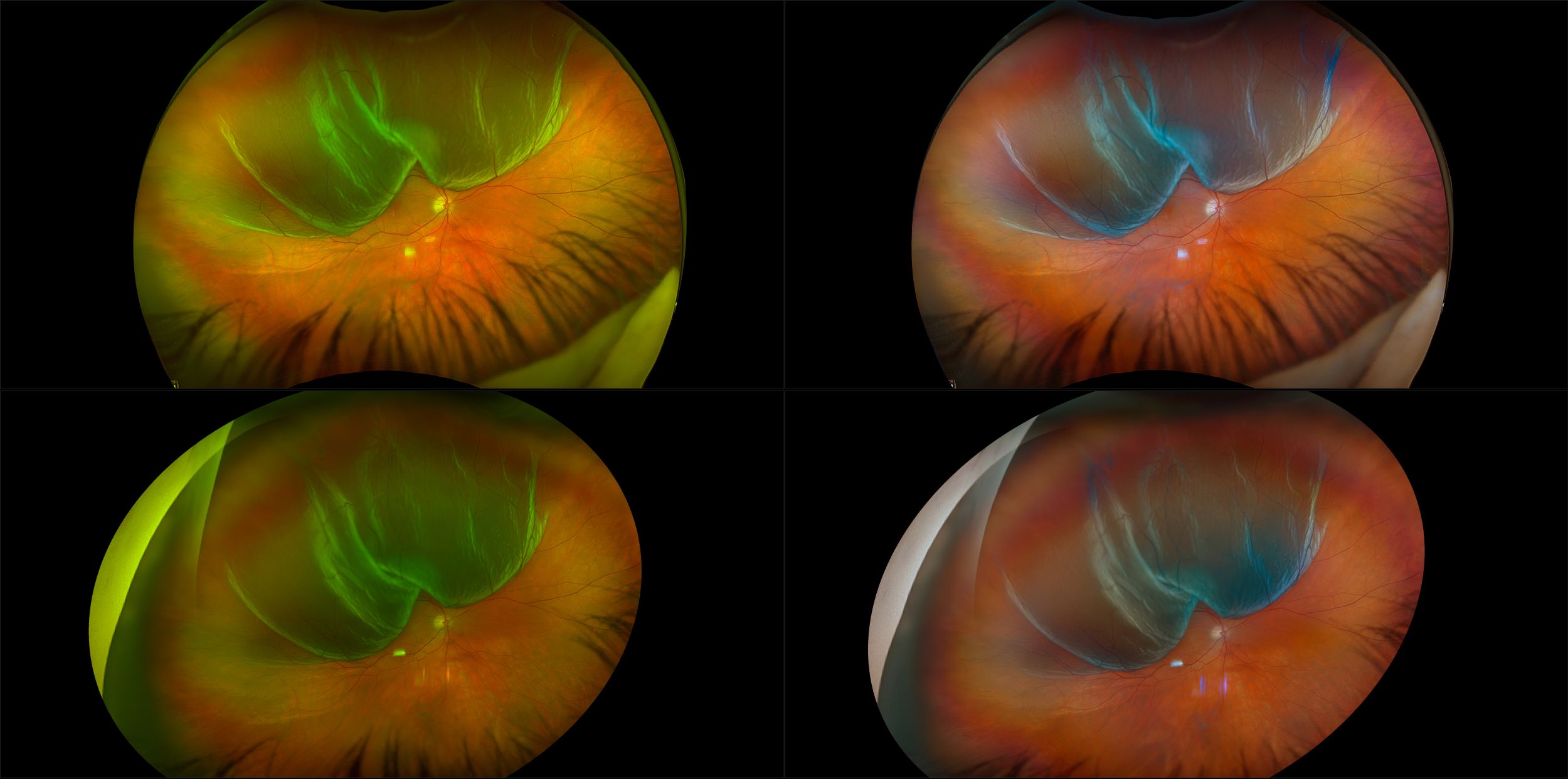 California - Bullous Retinal Detachment - Montage, RG, RGB