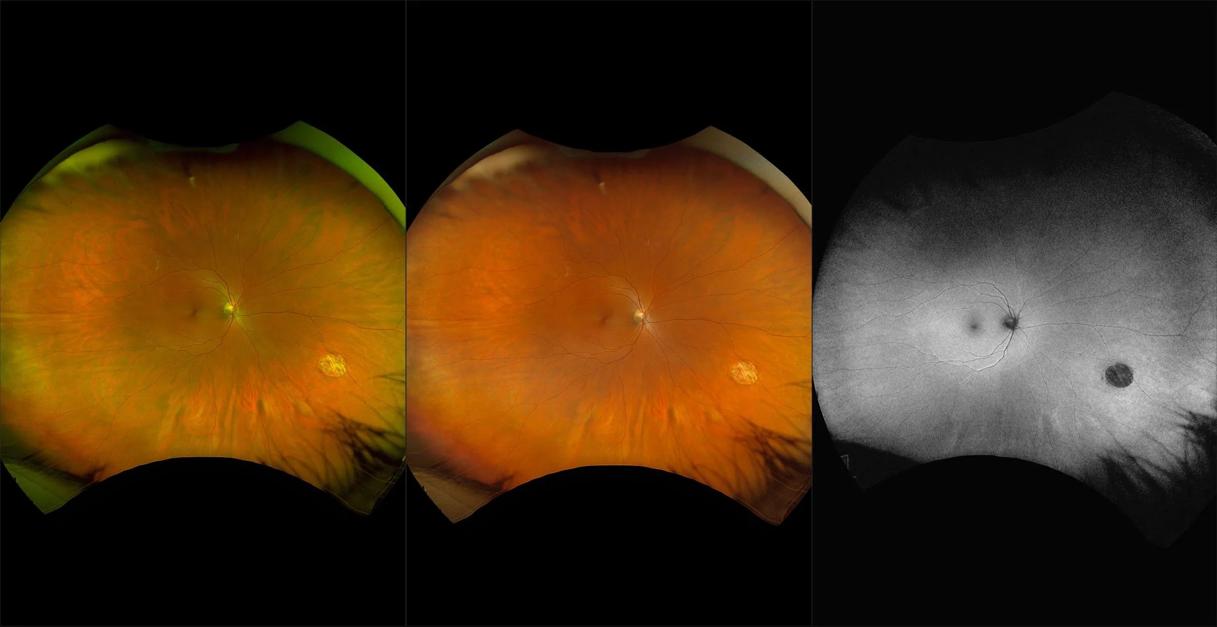 California - Scar with Congenital Hypertrophy of the RPE, RG, RGB, BAF