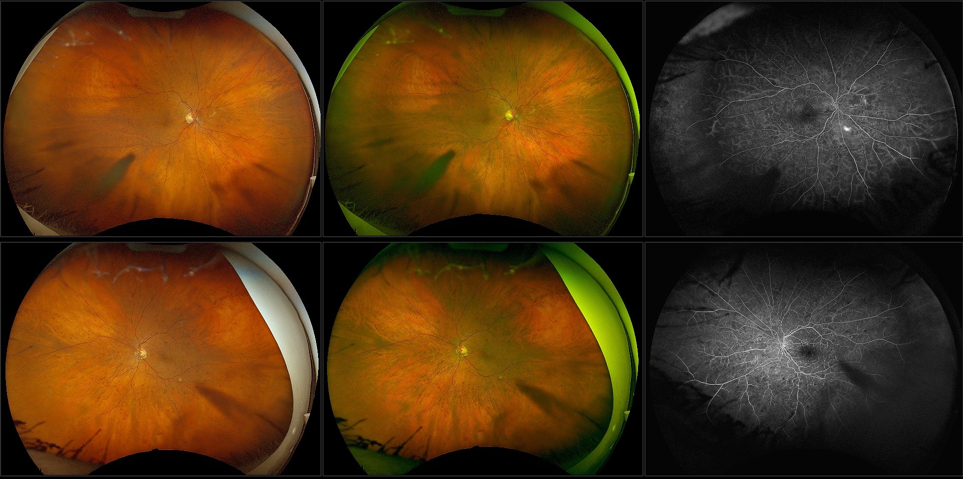 California - Early PDR with Severe Retinal Hemes, RG, RGB, FA