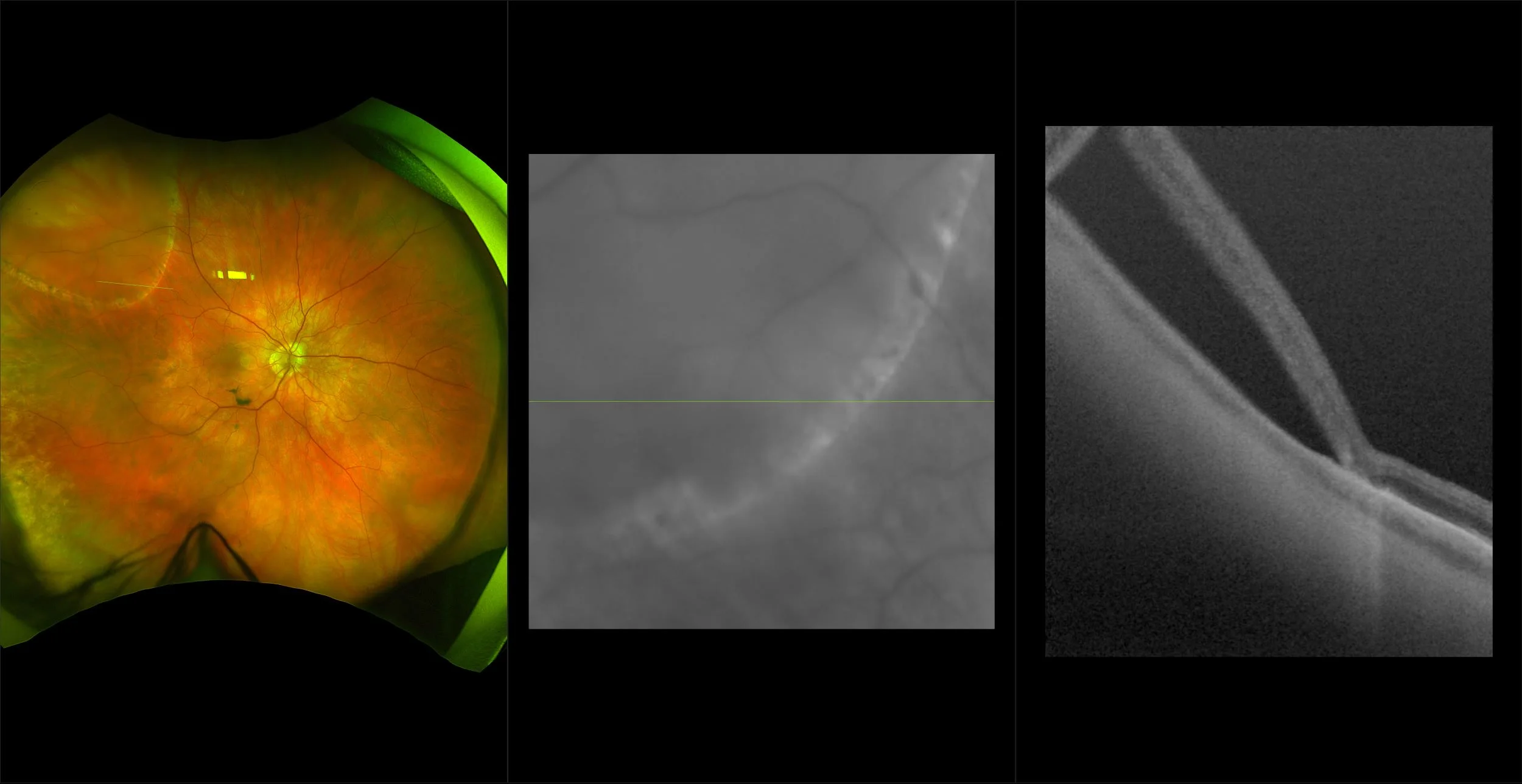 Silverstone - Senile Retinoschisis, RG