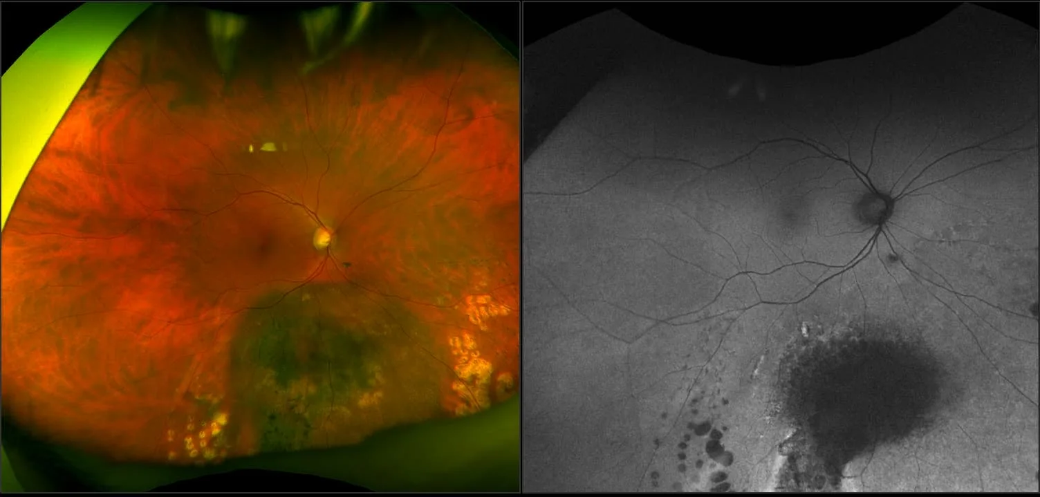 California - Choroidal Melanoma, RG, AF