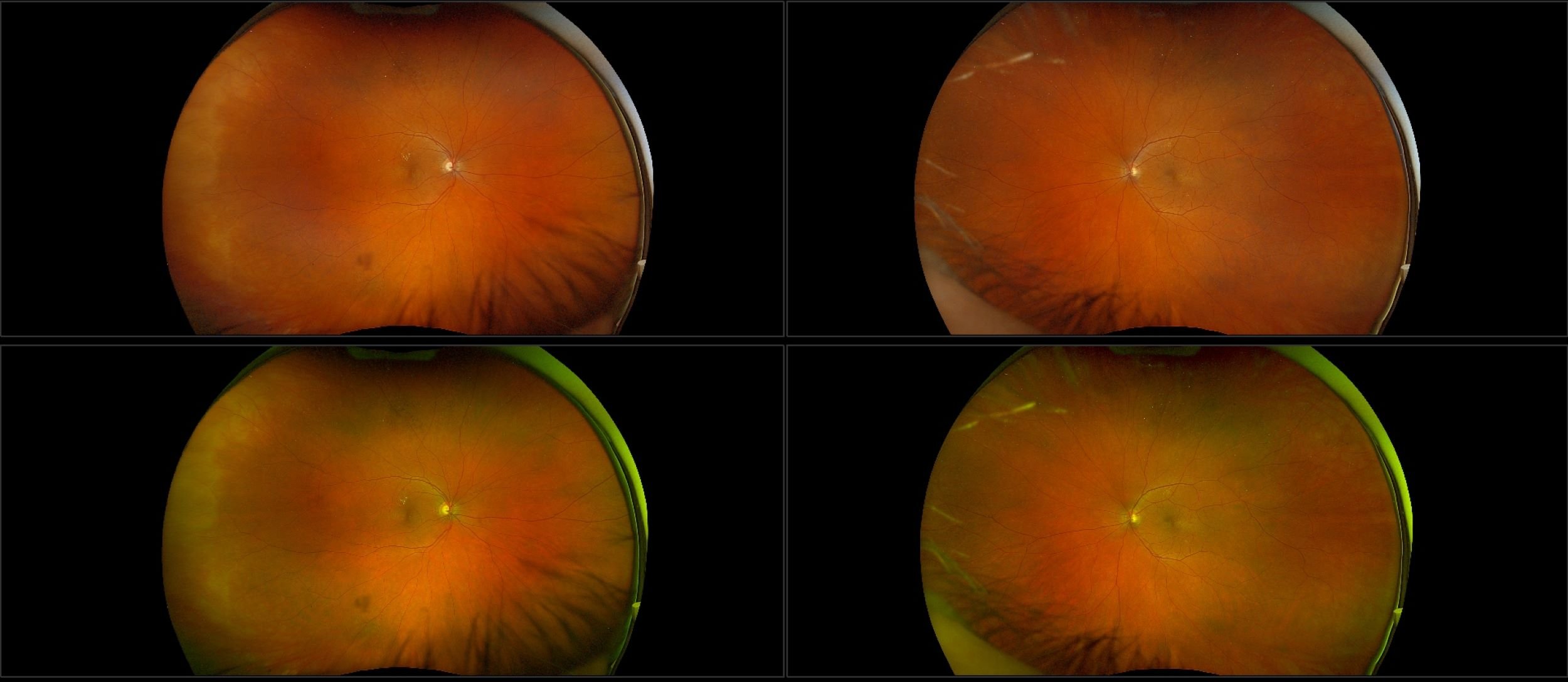 California - Nonproliferative Diabetic Retinopathy with Lipid, RG, RGB