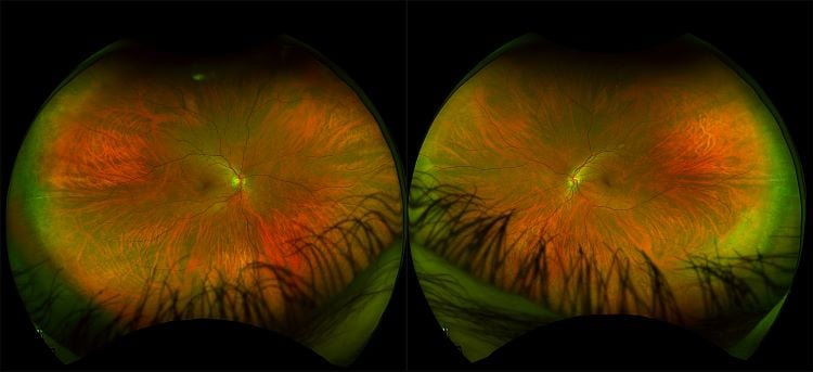 Monaco - Glaucoma, Deep Cup - RG, OCT - Retinal, ONH