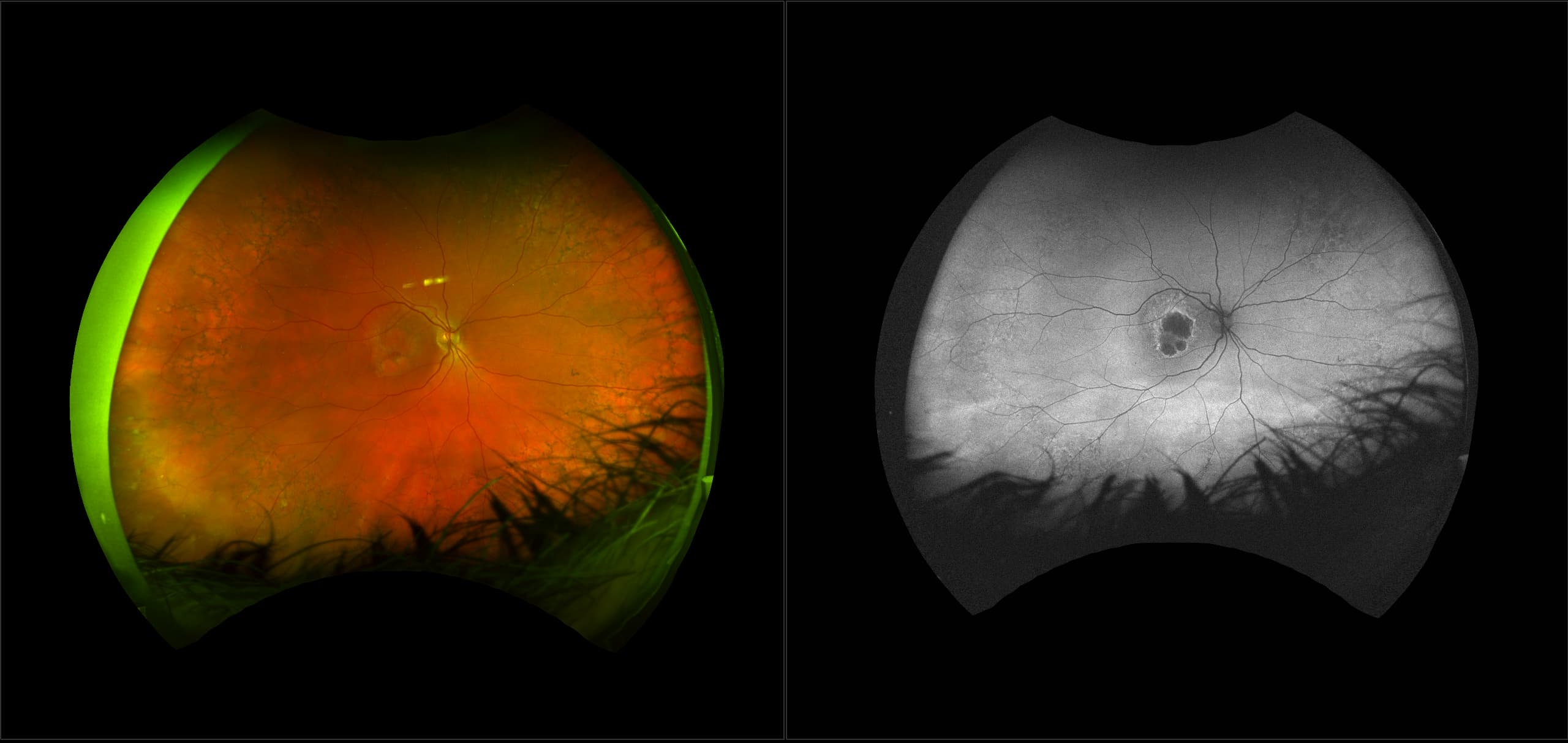 Age-related Macular Degeneration (AMD)