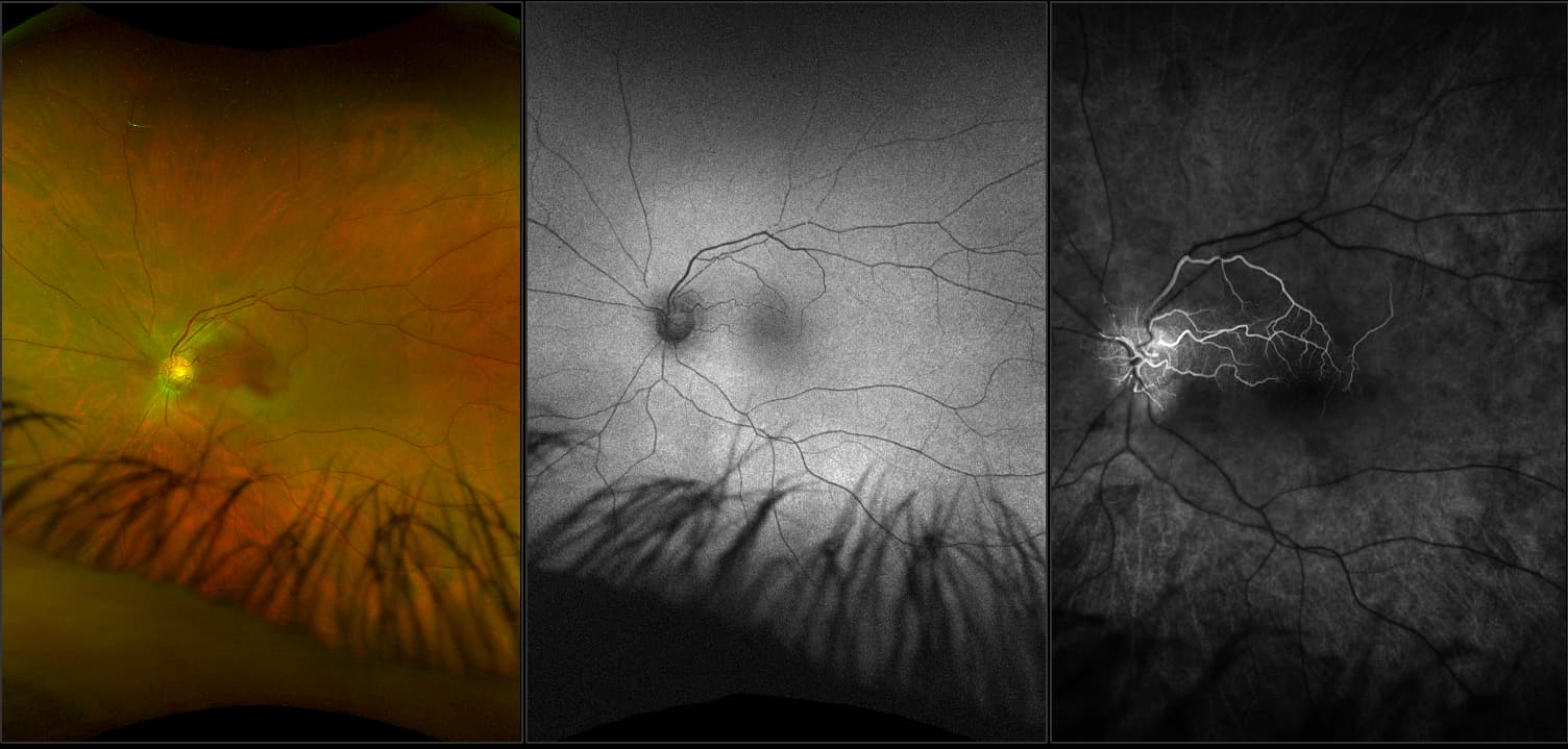 California - Branch Retinal Artery Occlusion, RG, AF, FA