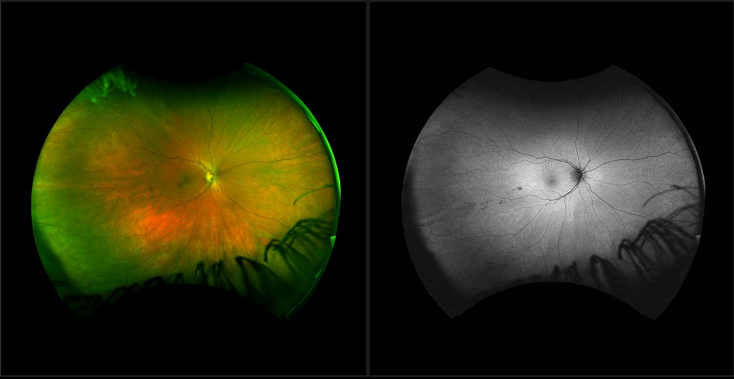Acute posterior multifocal placoid pigment epitheliopathy (APMPPE)
