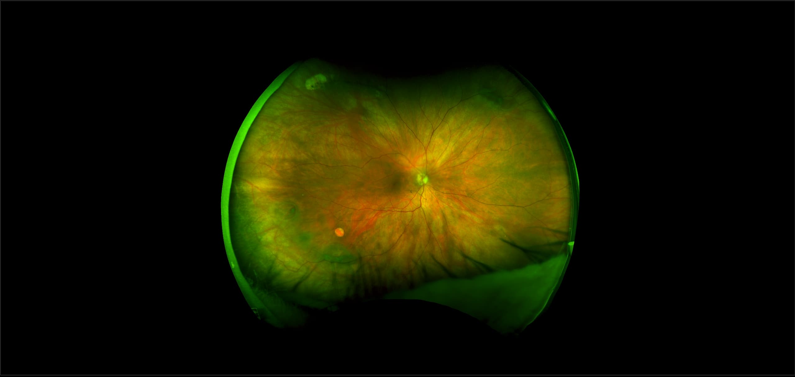 Retinal Hole Case Study